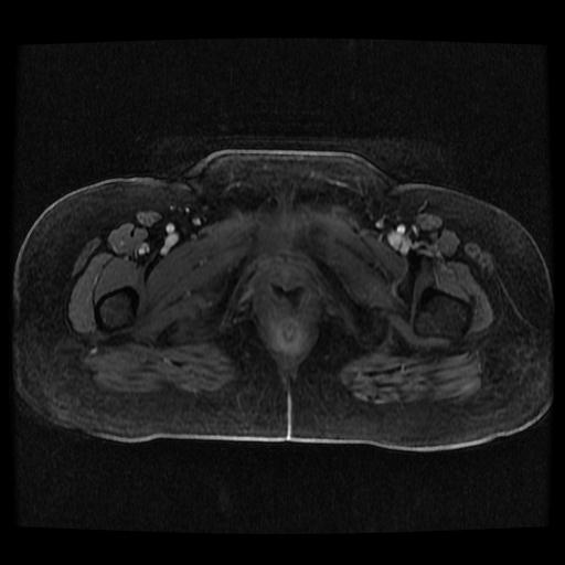 Cervical carcinoma (Radiopaedia 70924-81132 Axial T1 C+ fat sat 22).jpg