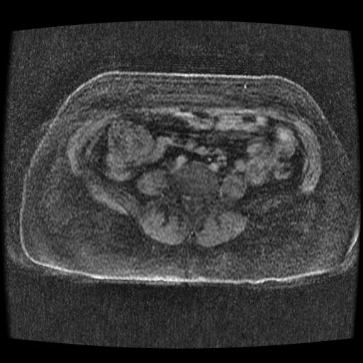 Cervical carcinoma (Radiopaedia 70924-81132 Axial T1 C+ fat sat 264).jpg