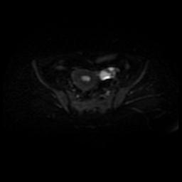 File:Cervical carcinoma (Radiopaedia 88010-104555 Axial DWI 17).jpg