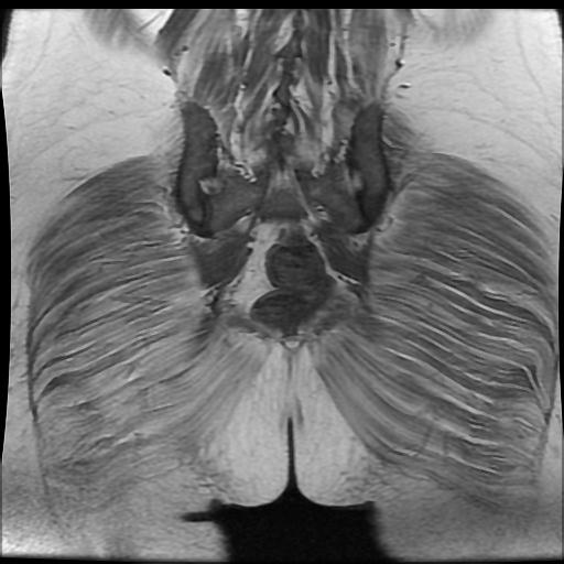File:Cervical carcinoma (Radiopaedia 88010-104555 Coronal T1 17).jpg