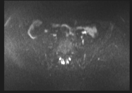File:Cervical carcinoma (Radiopaedia 88312-104943 Axial DWI 6).jpg