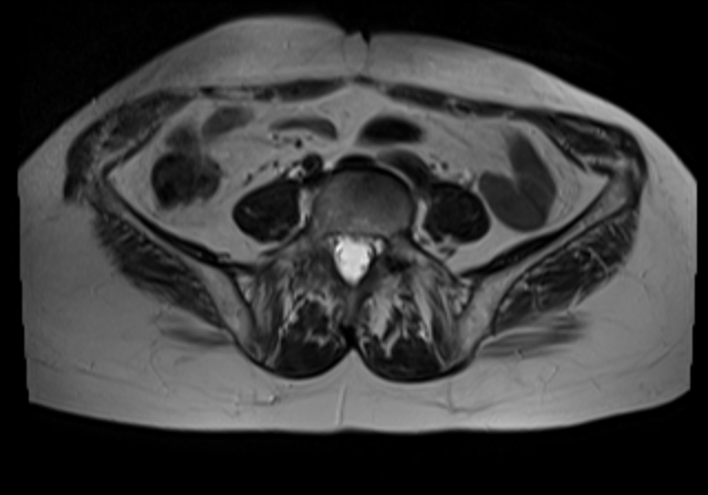 File:Cervical carcinoma (Radiopaedia 88312-104943 Sagittal T1 2).jpg