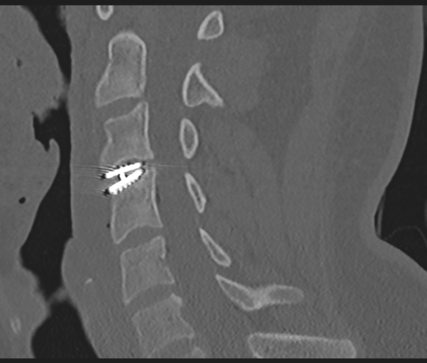 Cervical disc replacement (Radiopaedia 44025-47541 Sagittal bone window 39).png