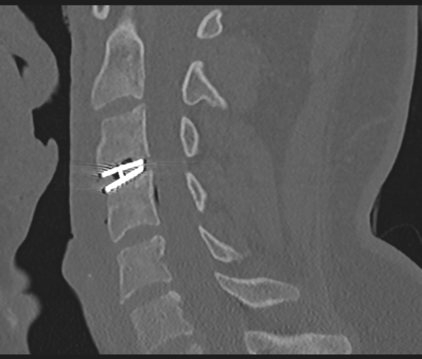 Cervical disc replacement (Radiopaedia 44025-47541 Sagittal bone window 40).png