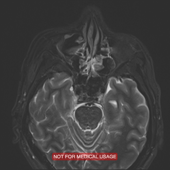 Cervical nerve schwannoma (Radiopaedia 27964-28221 C 11).jpg