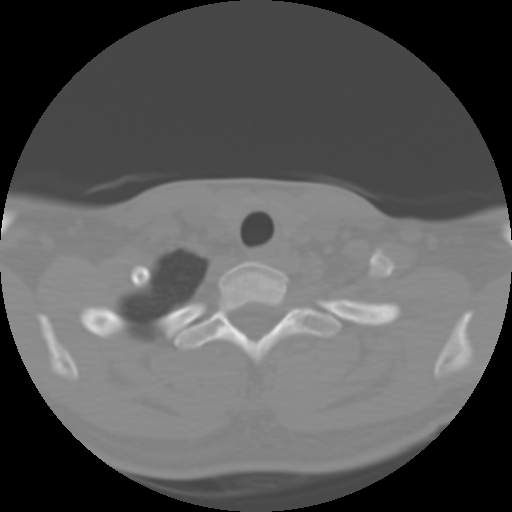 Cervical rib (Radiopaedia 71110-81363 Axial non-contrast 47).jpg