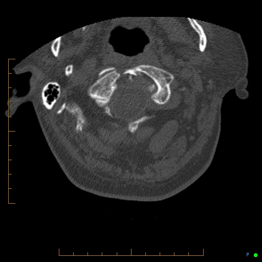 File:Cervical spine fracture - ankylosing spondylitis (Radiopaedia 76835-88706 Axial bone window 18).jpg