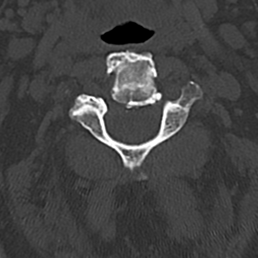 File:Cervical spine fracture - chalk stick (Radiopaedia 39116-41323 Axial bone window 26).png