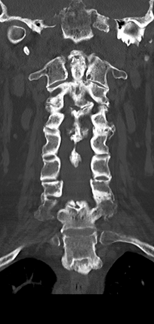 Cervical spine fracture - chalk stick (Radiopaedia 39116-41323 Coronal bone window 23).png