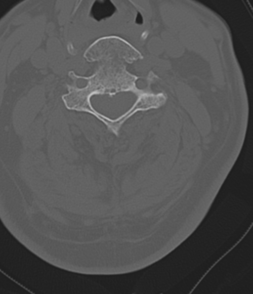 File:Cervical spine fracture in the setting of ankylosis (Radiopaedia 37038-38715 Axial bone window 30).png