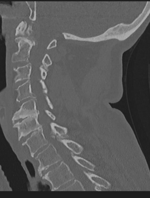 Cervical spondylolysis (Radiopaedia 49616-54811 Sagittal bone window 42).png