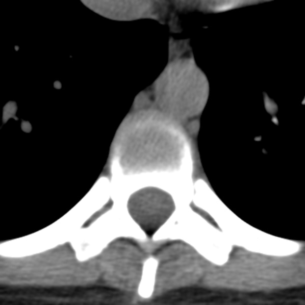 File:Chance fracture (Radiopaedia 36521-38081 Axial non-contrast 26).jpg