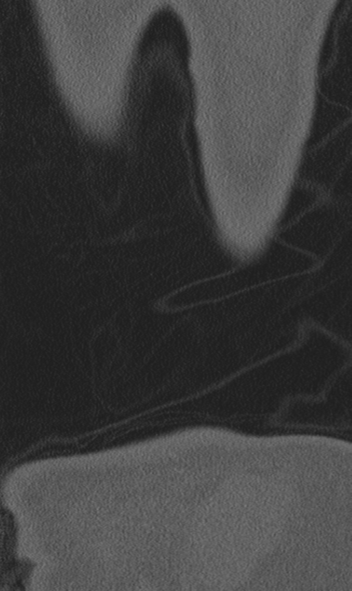 Chance fracture (Radiopaedia 40360-42912 Coronal bone window 76).png