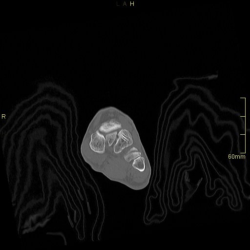 Chaput tubercle fracture (Radiopaedia 80319-93956 Coronal non-contrast 16).jpg