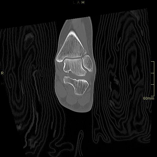 File:Chaput tubercle fracture (Radiopaedia 80319-93956 Coronal non-contrast 38).jpg