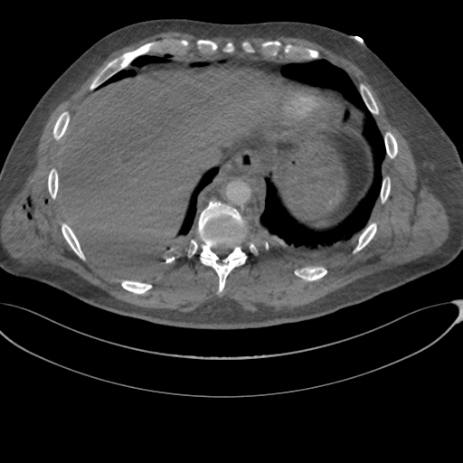 File:Chest multitrauma - aortic injury (Radiopaedia 34708-36147 A 244).png