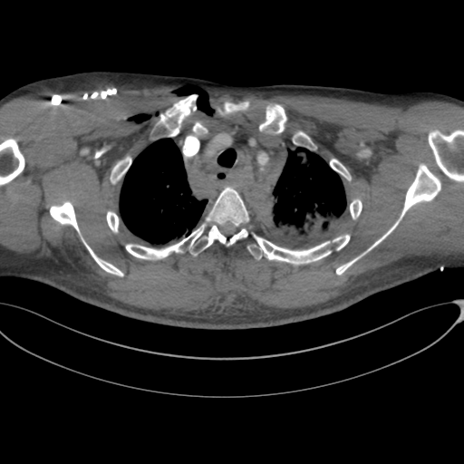 Chest multitrauma - aortic injury (Radiopaedia 34708-36147 A 59).png