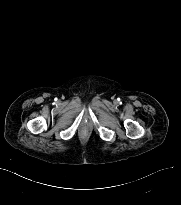 Cholangiocarcinoma with cerebral metastases (Radiopaedia 83519-98629 B 132).jpg