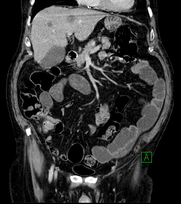 Cholangiocarcinoma with cerebral metastases (Radiopaedia 83519-98629 G 31).jpg