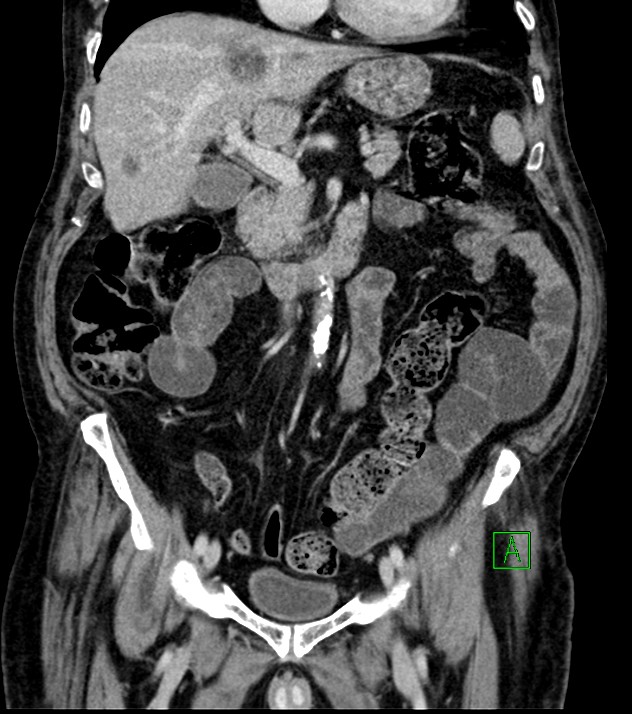 Cholangiocarcinoma with cerebral metastases (Radiopaedia 83519-98629 G 37).jpg