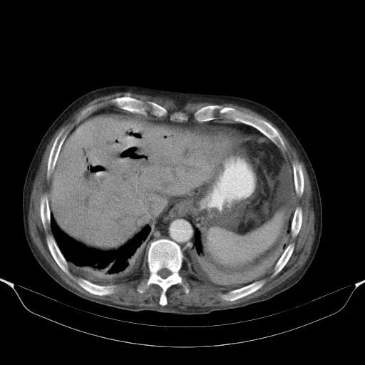 File:Cholangitis and abscess formation in a patient with cholangiocarcinoma (Radiopaedia 21194-21100 A 10).jpg