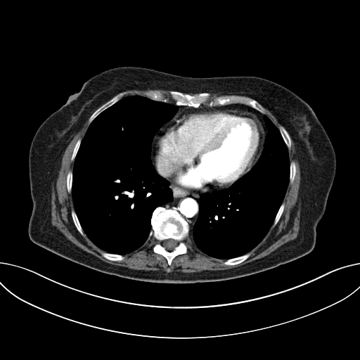 Cholecystoduodenal fistula due to calculous cholecystitis with gallstone migration (Radiopaedia 86875-103077 A 4).jpg