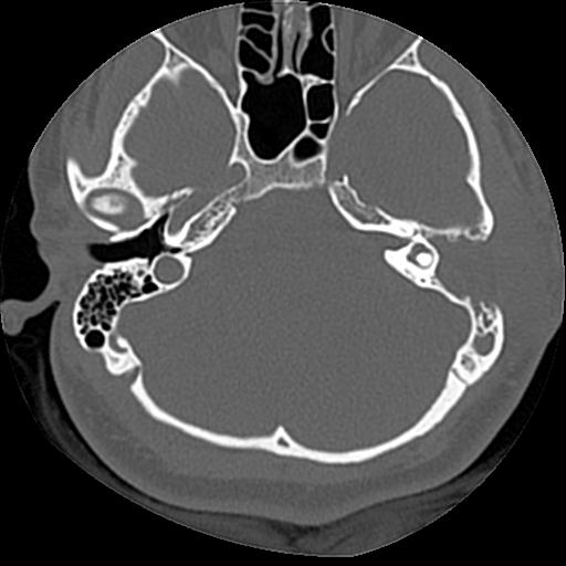 Cholesteatoma (Radiopaedia 84960-100474 Axial bone window 43).jpg