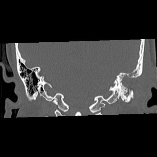 Cholesteatoma (Radiopaedia 84960-100474 Coronal bone window 43).jpg