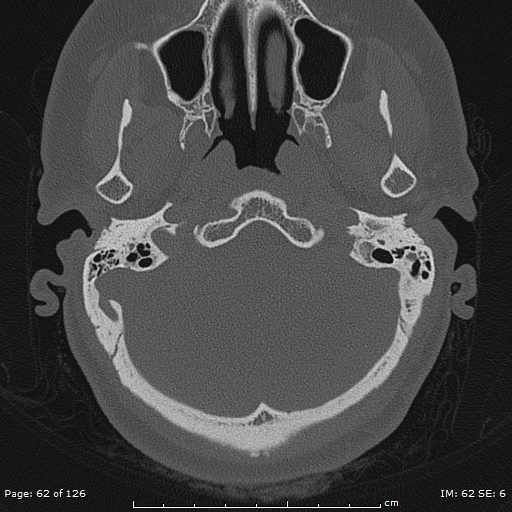 Cholesteatoma - external auditory canal (Radiopaedia 88452-105096 Axial bone window 25).jpg