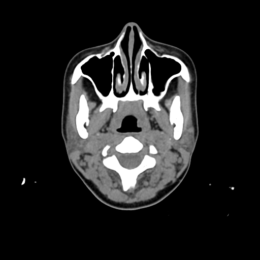 File:Chondroblastic osteosarcoma (Radiopaedia 67363-76741 Axial non-contrast 4).jpg