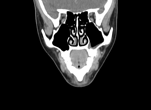 Chondroblastic osteosarcoma (Radiopaedia 67363-76741 D 31).jpg