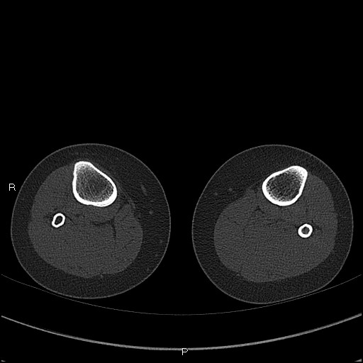 Chondroblastoma (Radiopaedia 62721-71030 Axial bone window 112).jpg