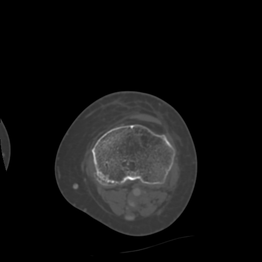 Chondrosarcoma - femur (Radiopaedia 64187-72954 Axial bone window 58).jpg