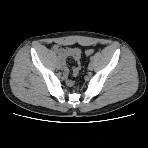 Chondrosarcoma of iliac wing (Radiopaedia 63861-72599 Axial non-contrast 72).jpg