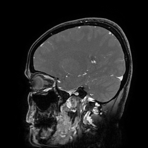 Chordoid glioma of third ventricle (Radiopaedia 91612-109340 F 78).jpg