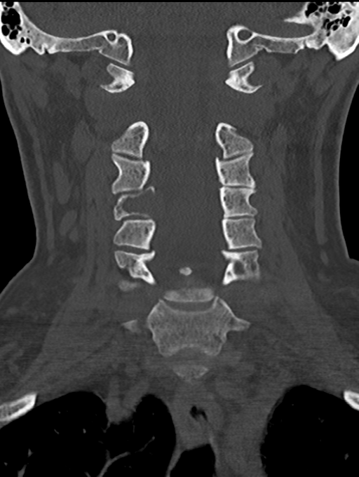 Chordoma (C4 vertebra) (Radiopaedia 47561-52188 Coronal bone window 25).png