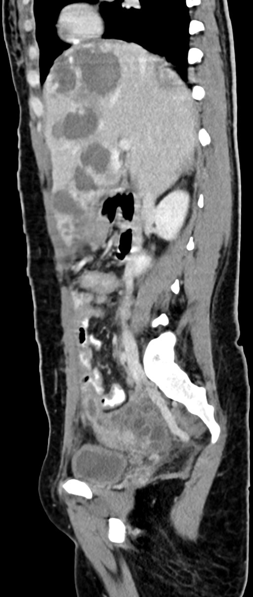 Choriocarcinoma liver metastases (Radiopaedia 74768-85766 C 113).jpg