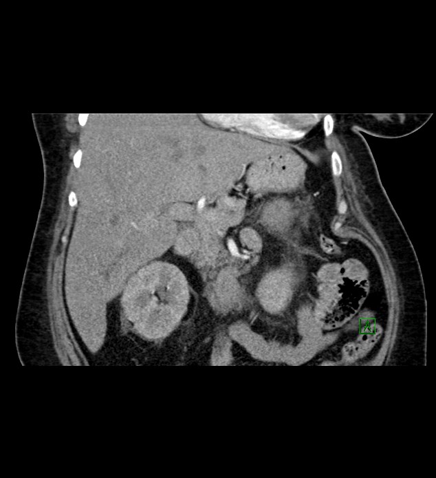 Chromophobe renal cell carcinoma (Radiopaedia 84239-99519 C 39).jpg