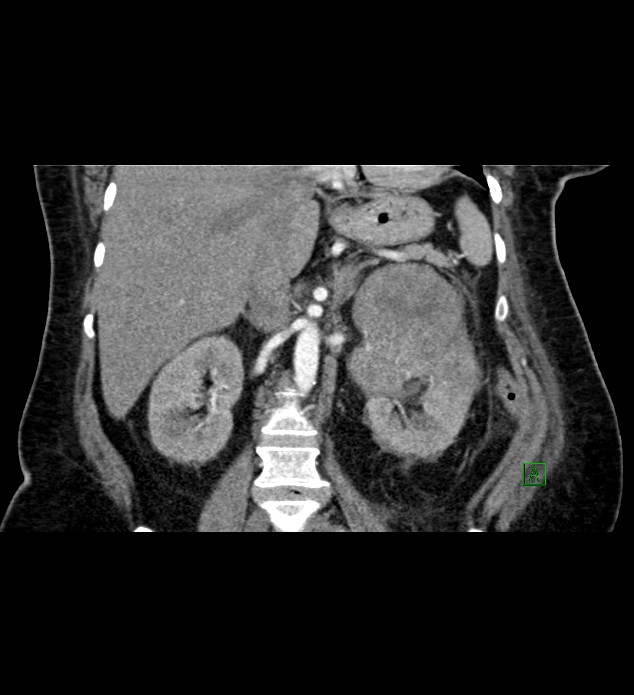 Chromophobe renal cell carcinoma (Radiopaedia 84239-99519 C 51).jpg