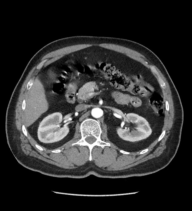 Chromophobe renal cell carcinoma (Radiopaedia 86879-103083 B 52).jpg