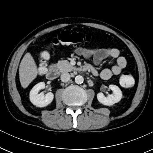 Chronic appendicitis complicated by appendicular abscess, pylephlebitis and liver abscess (Radiopaedia 54483-60700 B 70).jpg