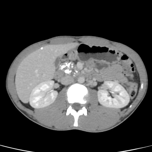 File:Chronic calcific pancreatitis (Radiopaedia 56280-62953 C 22).jpg