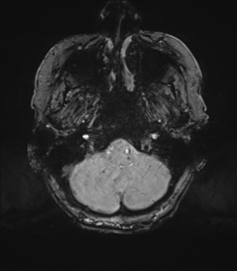 Chronic hypertensive encephalopathy (Radiopaedia 72844-83495 Axial SWI magnitude 11).png