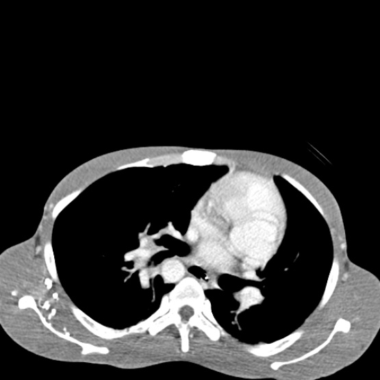 Chronic large bowel pseudo-obstruction (Radiopaedia 43181-46492 A 10).jpg