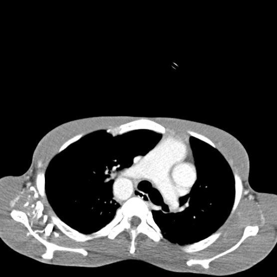 Chronic large bowel pseudo-obstruction (Radiopaedia 43181-46492 A 3).jpg