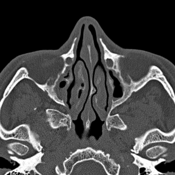 Chronic maxillary sinusitis (Radiopaedia 27879-28116 Axial bone window 22).jpg