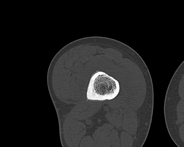 Chronic ostemyelitis of the femur with long sinus tract (Radiopaedia 74947-85982 Axial bone window 140).jpg