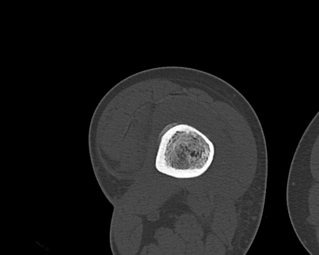 Chronic ostemyelitis of the femur with long sinus tract (Radiopaedia 74947-85982 Axial bone window 149).jpg