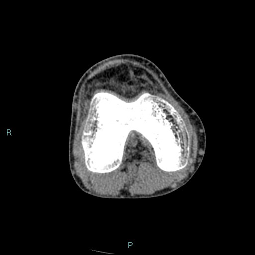 Chronic osteomyelitis (with Brodie abscess) (Radiopaedia 76405-88111 A 123).jpg