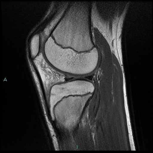 File:Chronic osteomyelitis (with Brodie abscess) (Radiopaedia 76405-88112 Sagittal PD 18).jpg